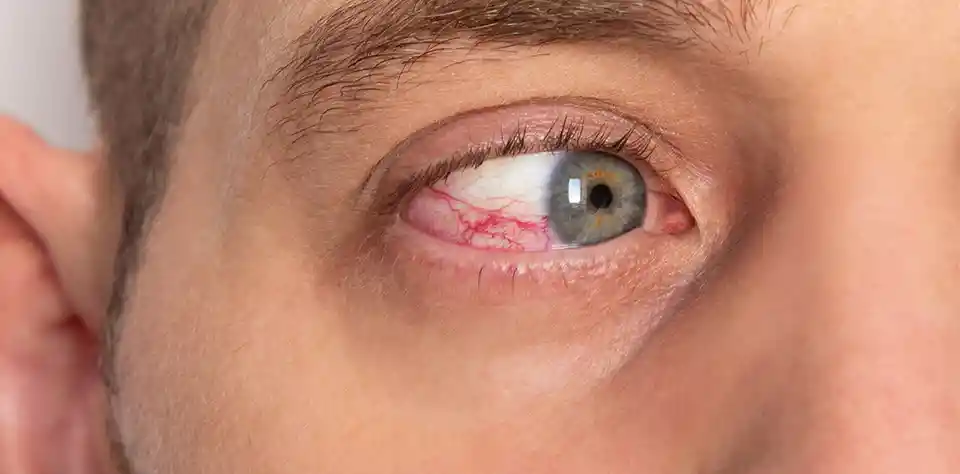 affordable treatment at renuka eye institute