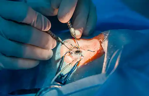 cost for cataract surgery