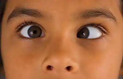 strabismus treatment