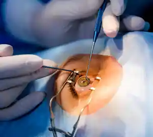 affordable cataract surgery cost in kolkata