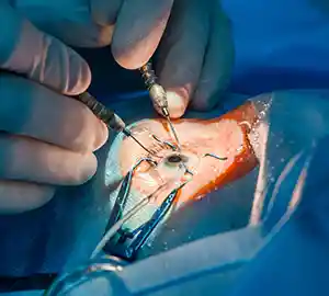 cataract operation cost in kolkata