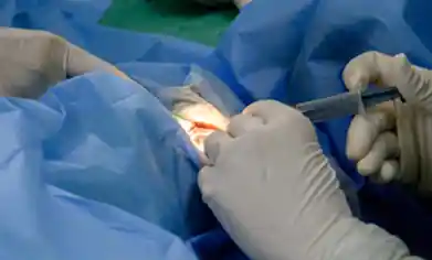 best cataract surgery in kolkata
