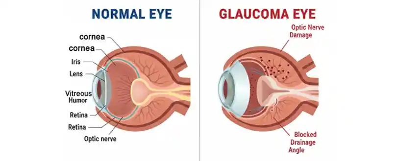 Glaucoma eye vs Normal eye